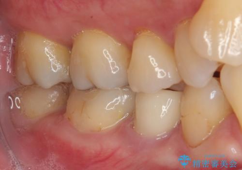 食べ物が引っかかるからやり替えたい　セラミックインレー修復の治療後
