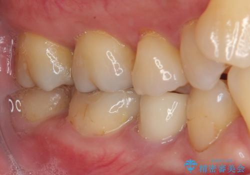 食べ物が引っかかるからやり替えたい セラミックインレー修復の治療後