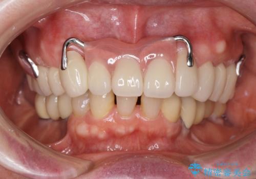 咬合の崩壊 金属床義歯で咬合機能の回復の治療後
