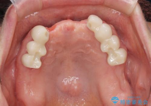 咬合の崩壊 金属床義歯で咬合機能の回復の治療中