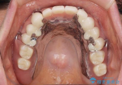 咬合の崩壊　金属床義歯で咬合機能の回復の治療後