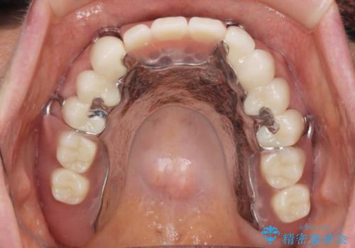 咬合の崩壊 金属床義歯で咬合機能の回復の症例 治療後