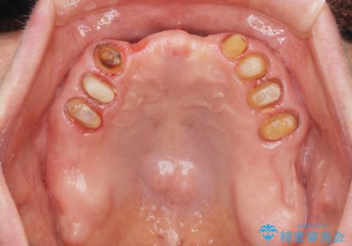 咬合の崩壊 金属床義歯で咬合機能の回復の治療中