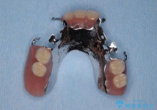 咬合の崩壊 金属床義歯で咬合機能の回復