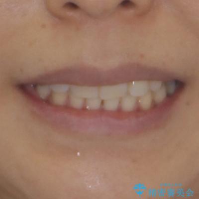 目立つ八重歯を改善 ワイヤー装置での抜歯矯正の治療後(顔貌)