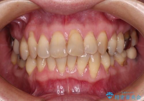 マウスピース矯正とセラミック治療で綺麗な口元にの症例 治療前