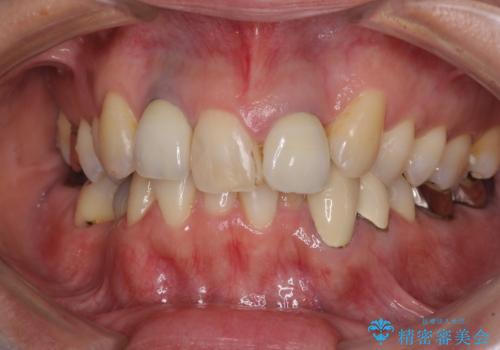 非対称の前歯を整えたい 矯正治療と審美治療の総合歯科診療の症例 治療前