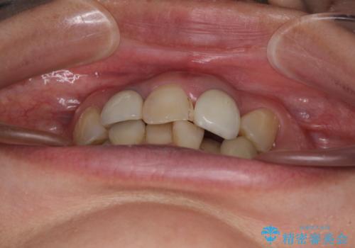 非対称の前歯を整えたい 矯正治療と審美治療の総合歯科診療の治療前