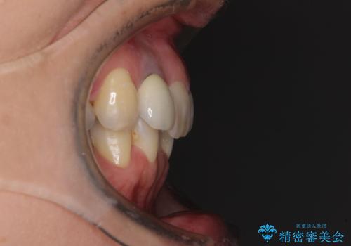 非対称の前歯を整えたい 矯正治療と審美治療の総合歯科診療の治療前