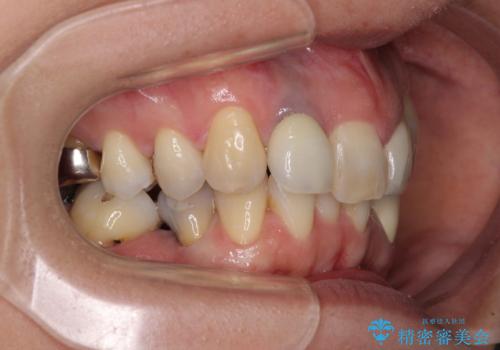 非対称の前歯を整えたい 矯正治療と審美治療の総合歯科診療の治療前