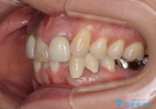 非対称の前歯を整えたい 矯正治療と審美治療の総合歯科診療の治療前