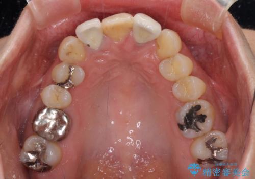 非対称の前歯を整えたい 矯正治療と審美治療の総合歯科診療の治療前