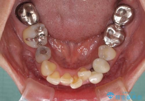 非対称の前歯を整えたい 矯正治療と審美治療の総合歯科診療の治療前