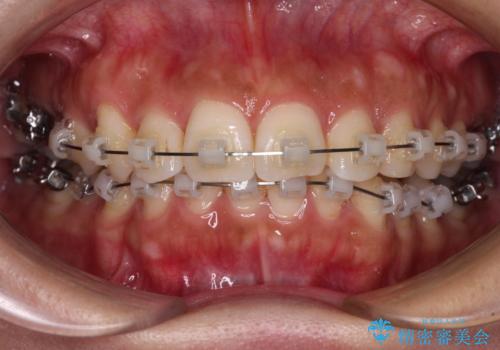目立つ八重歯を改善　ワイヤー装置での抜歯矯正の治療中