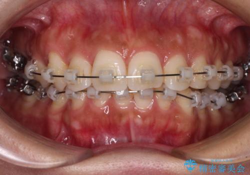 目立つ八重歯を改善 ワイヤー装置での抜歯矯正の治療中