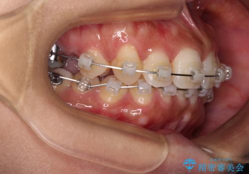 目立つ八重歯を改善 ワイヤー装置での抜歯矯正の治療中