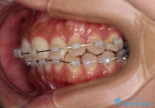 目立つ八重歯を改善　ワイヤー装置での抜歯矯正の治療中