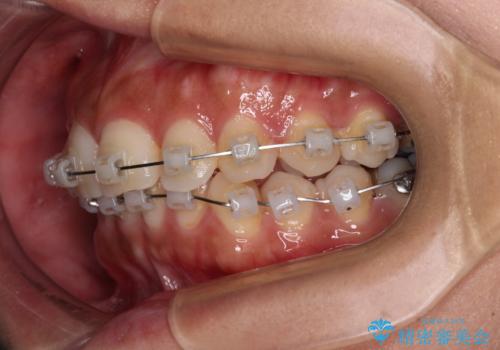 目立つ八重歯を改善 ワイヤー装置での抜歯矯正の治療中