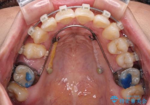 目立つ八重歯を改善　ワイヤー装置での抜歯矯正の治療中