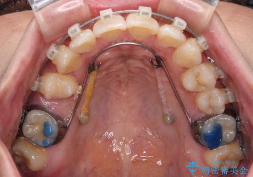 目立つ八重歯を改善 ワイヤー装置での抜歯矯正の治療中