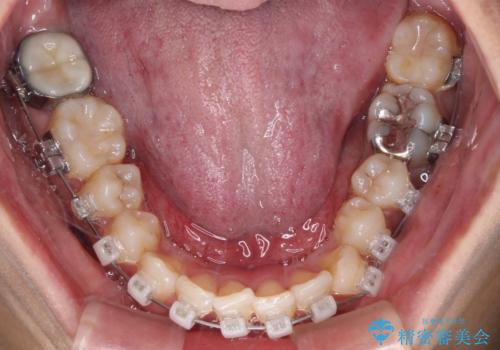 目立つ八重歯を改善 ワイヤー装置での抜歯矯正の治療中