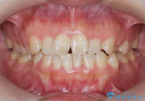 前歯のねじれをマウスピース矯正インビザラインで治療の症例 治療前