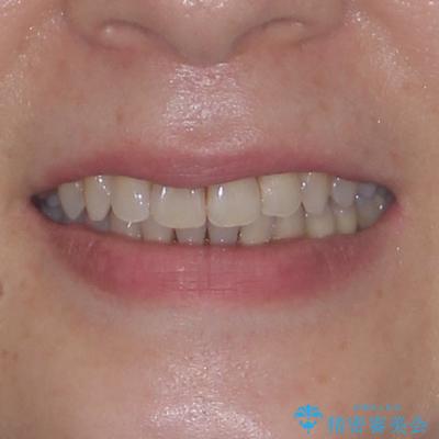 マウスピース矯正とセラミック治療で綺麗な口元にの治療後(顔貌)
