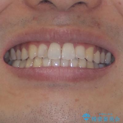 前歯のデコボコと突出感をマウスピース矯正できれいにの治療後(顔貌)