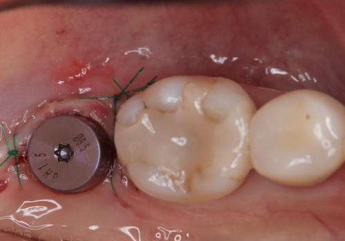 奥歯に歯を入れたい。インプラント治療の治療中