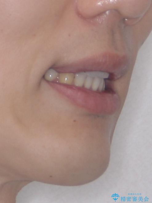 口元が出ているのが気になる。審美装置による抜歯矯正の治療後(顔貌)