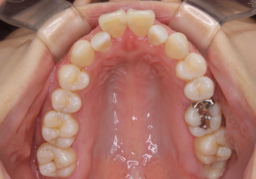 非抜歯、ワイヤーでの矯正治療。歯のがたつき、顎のズレ、出っ歯を治す。インビザラインが使えない方の治療前