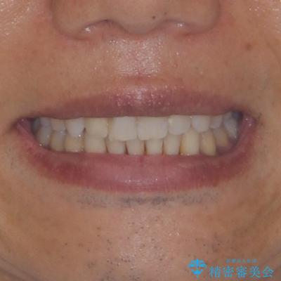 前歯のデコボコを治したい インビザラインによる矯正治療の治療後(顔貌)