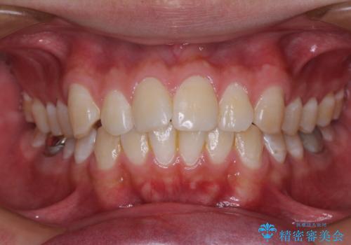 楽してデコボコを治したい ワイヤー矯正治療の症例 治療前