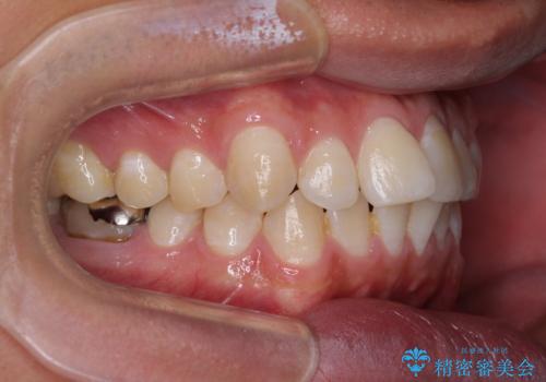 楽してデコボコを治したい ワイヤー矯正治療の治療前