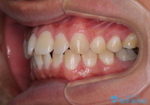 楽してデコボコを治したい ワイヤー矯正治療の治療前