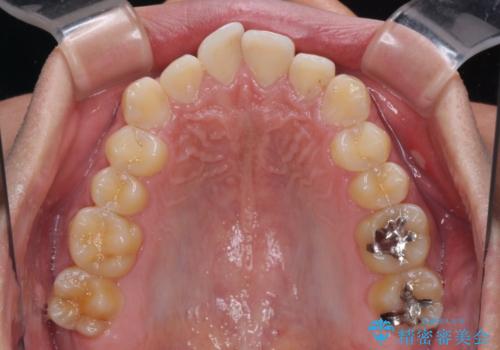 楽してデコボコを治したい ワイヤー矯正治療の治療前