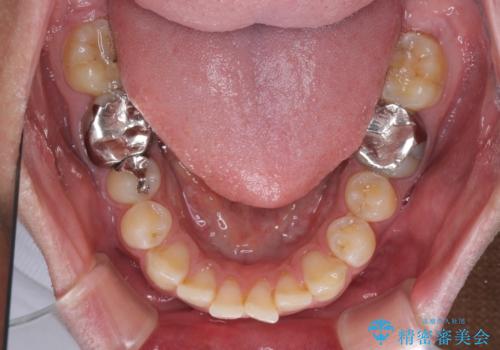 楽してデコボコを治したい ワイヤー矯正治療の治療前