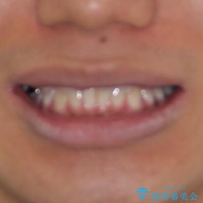 楽してデコボコを治したい ワイヤー矯正治療の治療前(顔貌)