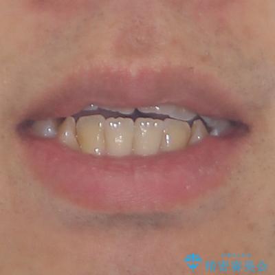 オープンバイトをインビザラインで矯正治療の治療前(顔貌)