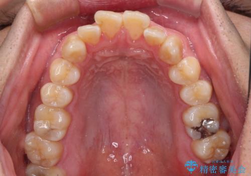 オープンバイトをインビザラインで矯正治療の治療前
