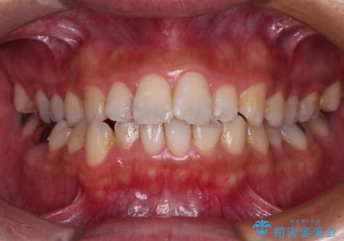 前歯のデコボコと突出感をマウスピース矯正できれいにの症例 治療前