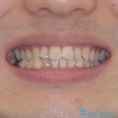 前歯のデコボコと突出感をマウスピース矯正できれいにの治療前(顔貌)