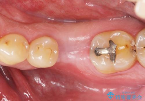 奥歯の欠損　インプラント治療の治療中