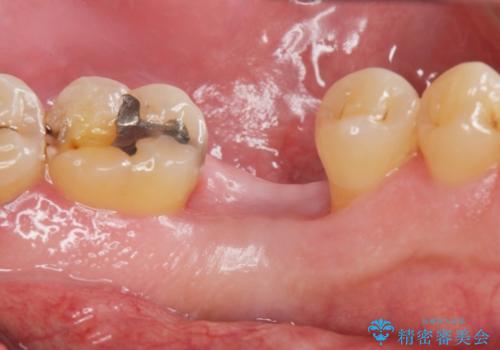 奥歯の欠損　インプラント治療の治療前