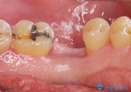 奥歯の欠損 インプラント治療の治療前