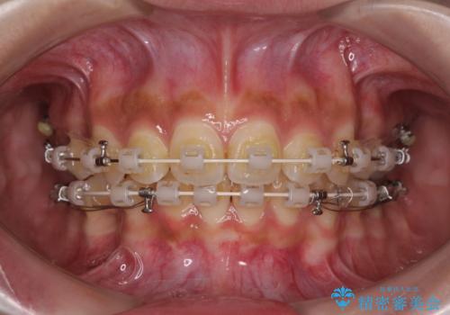 飛び出した前歯と八重歯を改善　ワイヤー装置での抜歯矯正の治療中