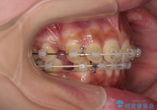飛び出した前歯と八重歯を改善　ワイヤー装置での抜歯矯正の治療中