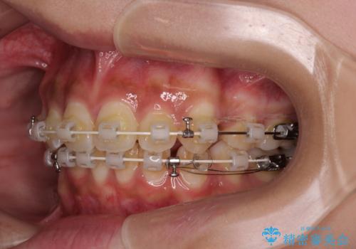 飛び出した前歯と八重歯を改善 ワイヤー装置での抜歯矯正の治療中