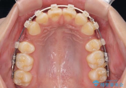 飛び出した前歯と八重歯を改善　ワイヤー装置での抜歯矯正の治療中