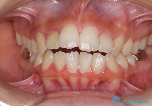 開咬と前突を改善 ワイヤー装置での抜歯矯正の症例 治療前